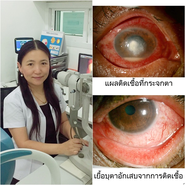 แพทย์เตือนเล่นสงกรานต์รุนแรง น้ำไม่สะอาด ใส่คอนแทคเลนส์ ระวัง!
